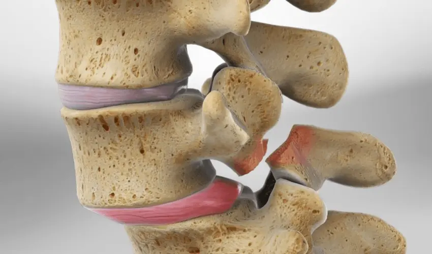 Ilustração anatômica de espondilolistese