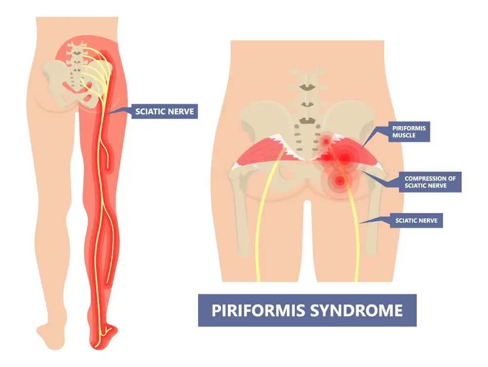 Ilustração anatômica de síndrome do músculo piriforme