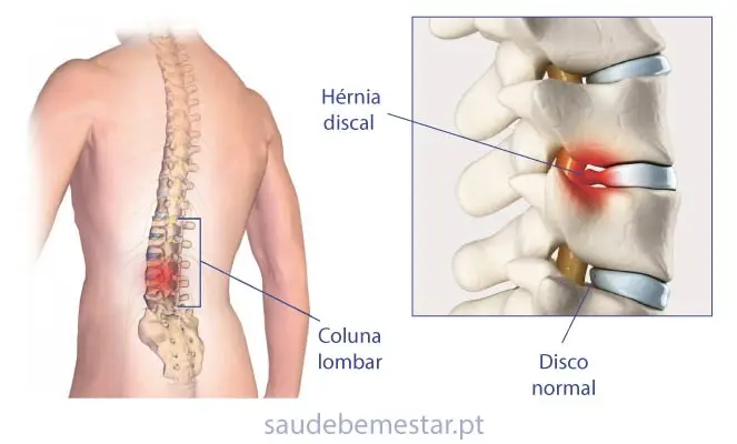 Ilustração anatômica de hérnia de disco lombar